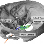 Transforamenal ablation needle concept