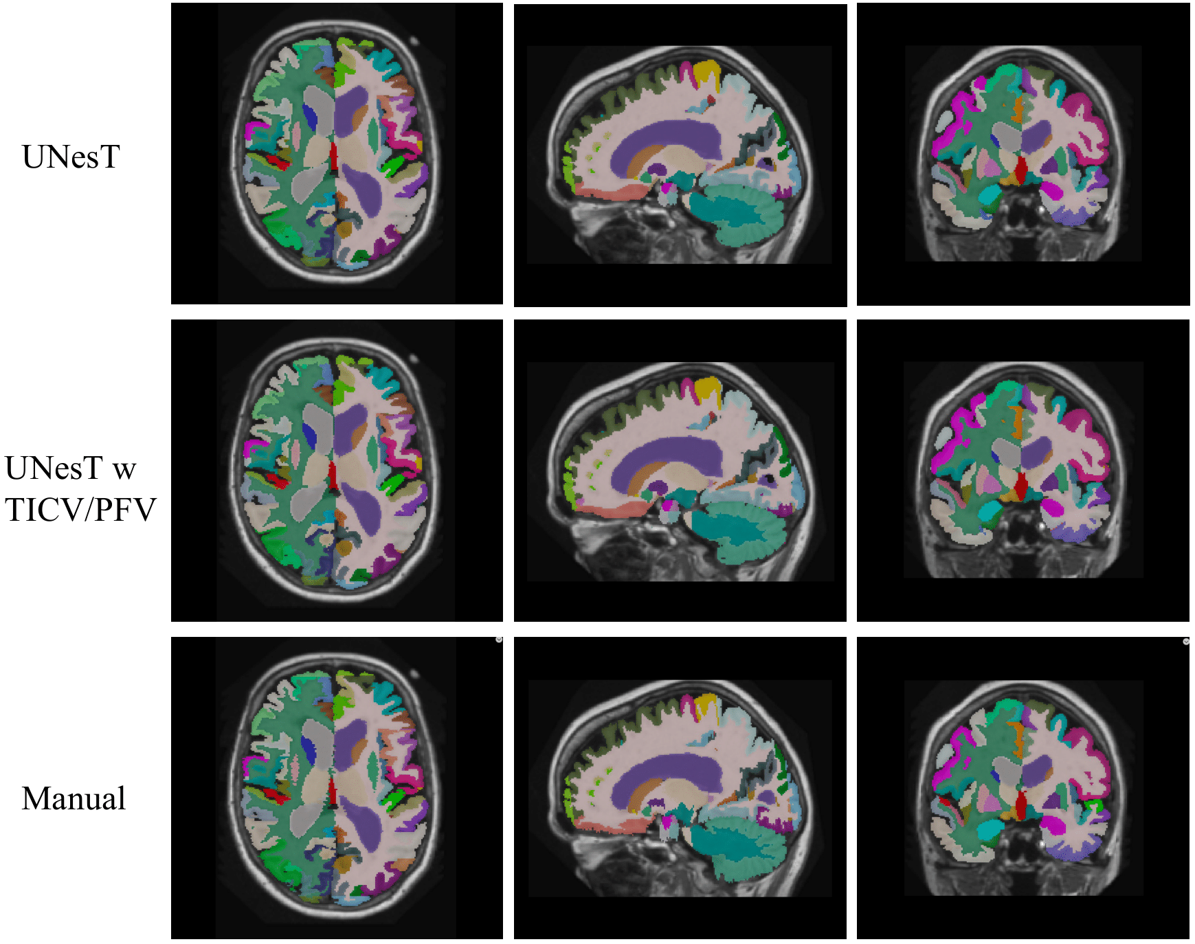 Deep Brain Stimulation | Medical-image Analysis and Statistical ...