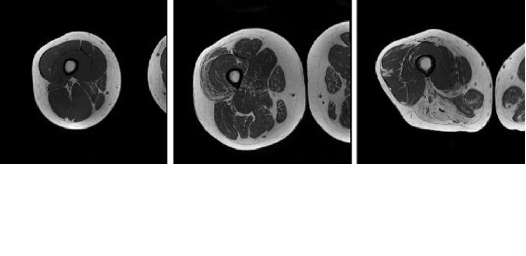 MRI reveals muscle damage in myositis patients MRI reveals muscle damage in myositis patients